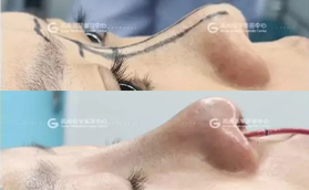 廣州高尚醫(yī)療門診部膨體+耳軟骨隆鼻案例對比照