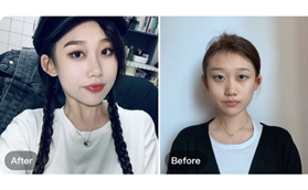 南京美萊整形醫(yī)療美容朱姍姍明眸翹睫大眼術(shù)案例