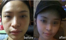 杭州時光面部自體脂肪填充案例