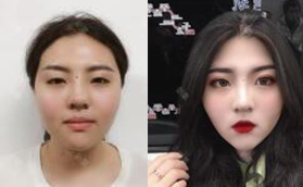 蘭州夢想整形醫(yī)院趙梅霞雙眼皮怎么樣？價格案例大曝光！