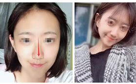 5年隆鼻2次，歪鼻的她終于告別鼻梁低、鼻基底凹陷、鼻骨寬