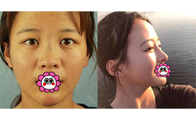 昆明夢想張燕雄肋軟骨隆鼻案例:恢復后鼻部自然流暢很好看