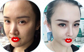 都說我做鼻綜合1到3個月變化蠻大 尤其是難看的大鼻頭沒了