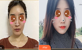 都說喬愛軍脂肪填充收費(fèi)高在北京京韓做VST藝術(shù)面雕覺得值