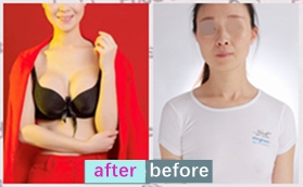 沈陽美萊醫(yī)院高國林傲若拉閃耀女王胸對比案例