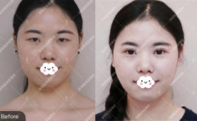 誰說深圳瑞芙臣割雙眼皮價(jià)格貴，我做后感覺性價(jià)比蠻高的