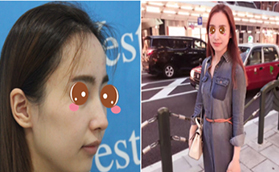 北京去斑需要多錢？北京藝星蜂巢皮秒去斑真人案例供參考