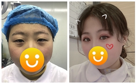 株洲韓美陶正全切雙眼皮腫泡眼真人改善案例