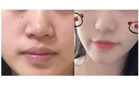 體驗(yàn)張家界依萊美鼻頭整形技術(shù)，精致的鼻子你也可以有