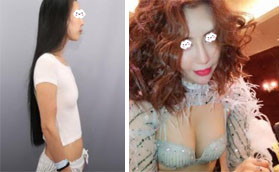 深圳陽光是正規(guī)醫(yī)院，在這做的傲諾拉假體隆胸性價(jià)比很高