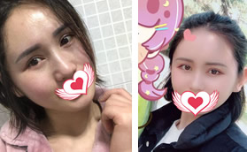 記錄鄭州悅美整形姚剛為我做自體脂肪填充全臉的消腫過程