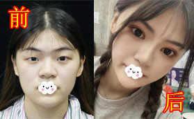 查詢寶雞愛容妍是正規(guī)醫(yī)院 割雙眼皮后悔該一起做假體隆鼻