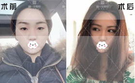 對比價格和效果后選擇寶雞高一生做了切開雙眼皮