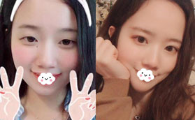 推薦下我的網(wǎng)紅原生態(tài)雙眼皮是找寶雞韓美整形閆相友做的