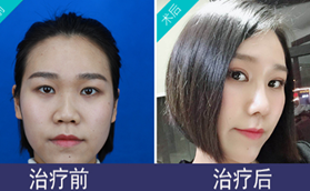 株洲愛(ài)思特肖學(xué)敏隆鼻+鼻翼縮小綜合手術(shù)案例