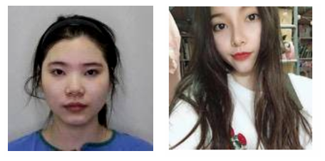 南京米尚恩醫(yī)療美容黃發(fā)自然美學(xué)鼻綜合案例