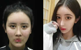 我面部脂肪填充過量失敗去鄭荃麗格做抽吸修復才恢復原貌