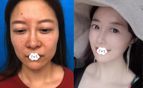 感覺深圳容術(shù)面部脂肪填充價格合理，做了科爾曼脂肪填充