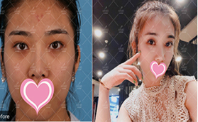 我在北京美萊花費上萬元做原生隱痕美眼術(shù)效果真心驚艷