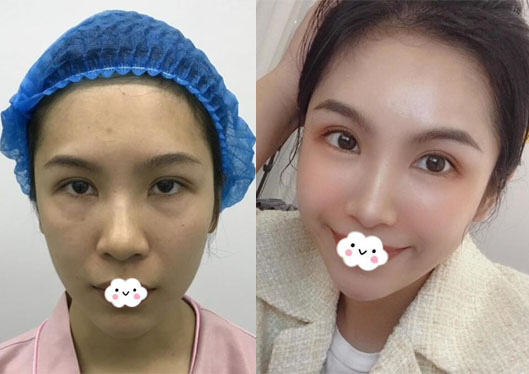 深圳貝漾美天曹思佳雙眼皮修復(fù)+祛眼袋效果與價格成正比