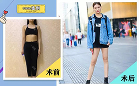 廣州如花醫(yī)療美容門診部大腿吸脂前后對比案例