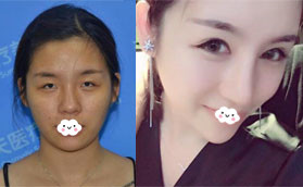 我找深圳春天醫(yī)院楊淑云割雙眼皮時(shí)還開內(nèi)眼角和外眼角了