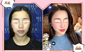 廣東美恩整形美容醫(yī)院自體脂肪面部填充案例合集