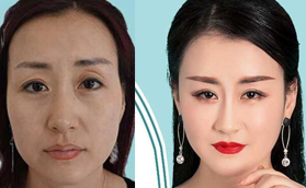 蘭州姜醫(yī)生整形姜春仁院長的面部脂肪填充案例-讓童顏再現(xiàn)