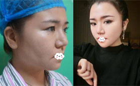 千萬別做光纖吸脂？我找深圳美芮王權做面部吸脂半年變化