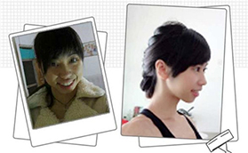 青島維樂(lè)口腔醫(yī)院楊春犁半隱形陶瓷矯正案例