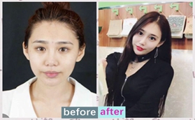 沈陽創(chuàng)美薈邊志超眶隔脂肪釋放祛眼袋案例