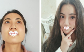 親身經(jīng)歷雙下巴吸脂七天已消腫 臉型精致初現(xiàn)小V臉