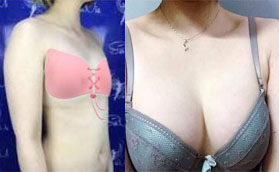 都說深圳藝星朱輝雙眼皮手術(shù)好，我做曼托假體隆胸也很棒