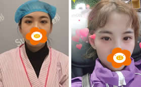 在鄭州辰星做切開(kāi)雙眼皮+去皮去脂3個(gè)月弧度寬度我都很滿意