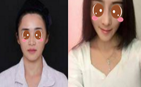 北京沃爾劉彥軍正規(guī)靠譜嗎？馮雁平自體軟骨鼻綜合效果圖