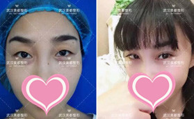 武漢美都整形張浩醫(yī)生給我做的雙眼皮價(jià)格不貴還很自然