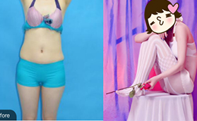 花費(fèi)四萬(wàn)多在北京歐揚(yáng)做的腰腹吸脂給大家看看效果圖