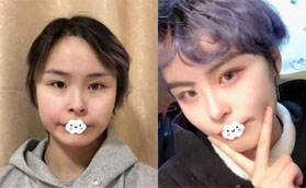 面部填充失敗好后悔 花高價在深圳蘭茂梵美整形做脂肪修復(fù)