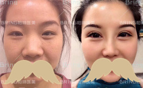 雙眼皮和隆鼻一起做好么?眼鼻綜合案例效果/價(jià)格表分享