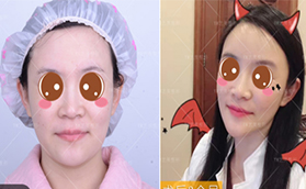 花費(fèi)三萬多在北京藝美找王東做自體脂肪面部填充失敗修復(fù)