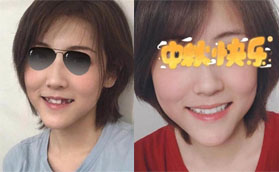 趁價格優(yōu)惠在深圳世紀河山口腔做了6顆韓國美格真種植牙