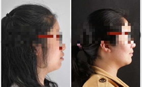 牙槽骨前突的我，在南京美奧口腔牙齒正畸后的對比效果圖