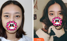 ?找太原楊俊斐做的切開雙眼皮剛滿兩個月忍不住拿出炫耀