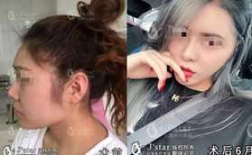 到武漢匠星醫(yī)療美容找雷云飛做鼻子后再也不怕側(cè)顏大鼻頭