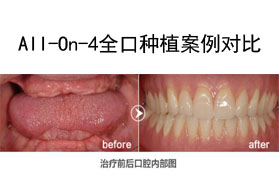 良心醫(yī)生不建議種植牙？我在深圳做All-On-4全口種植牙的感受