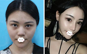 深圳麗港麗格謝俊擅長(zhǎng)鼻修復(fù) 選這正規(guī)醫(yī)院做了鼻綜合隆鼻