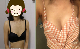 北京雅靚假體隆胸真人案例看張春彥隆胸技術(shù)是否靠譜？