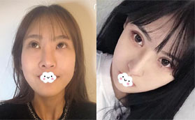 雙眼皮術(shù)后1年又花1W多來深圳潤澤瑞尼絲做耳軟骨復(fù)合隆鼻