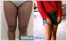 沈陽盛京尚美醫(yī)療美容陳迪院長大腿安全吸脂對比圖