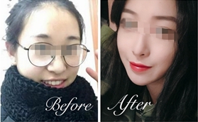 南陽(yáng)天后醫(yī)療美容醫(yī)院廖丹膨體隆鼻案例